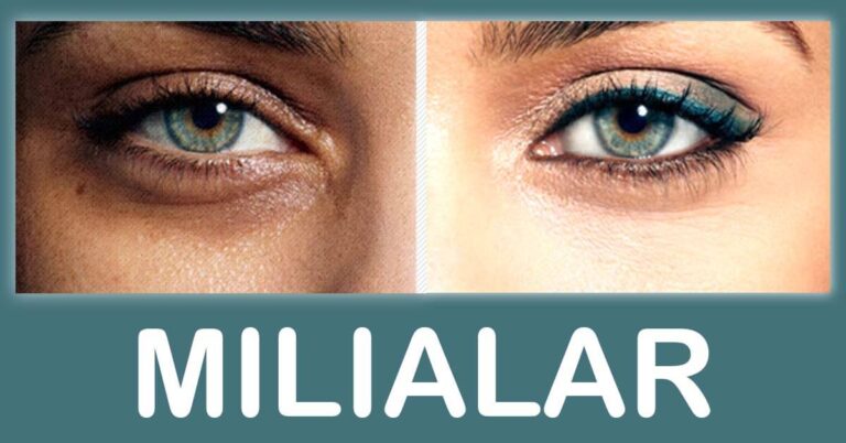 Understanding Milialar: A Comprehensive Guide